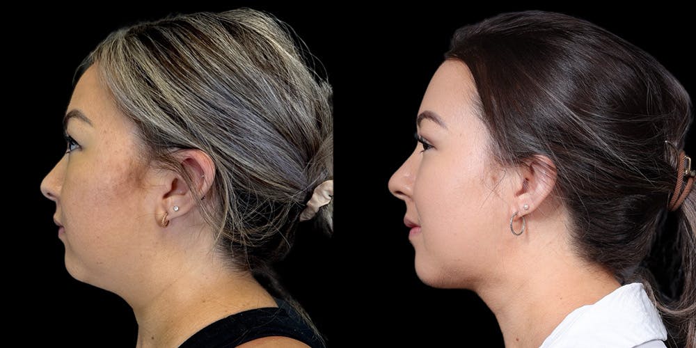 Chin Before & After Gallery - Patient 179752091 - Image 4