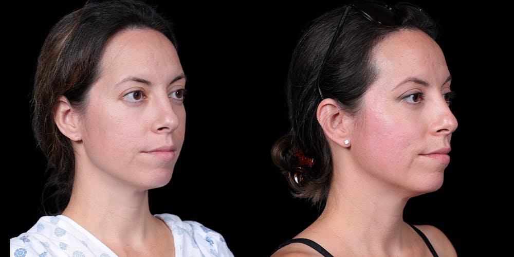 Laser Resurfacing Before & After Gallery - Patient 375310 - Image 2
