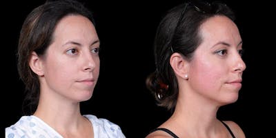 Laser Resurfacing Before & After Gallery - Patient 375310 - Image 2