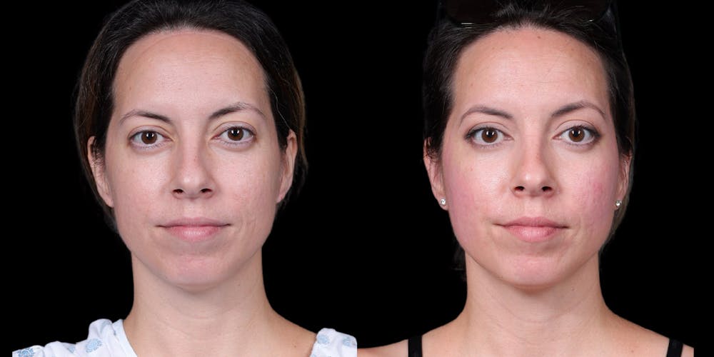 Laser Resurfacing Before & After Gallery - Patient 375310 - Image 1