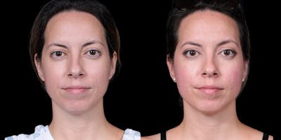 Laser Resurfacing Before & After Gallery - Patient 375310 - Image 1