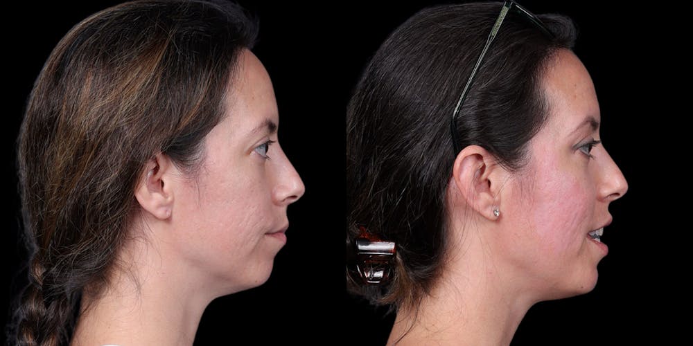 Laser Resurfacing Before & After Gallery - Patient 375310 - Image 3