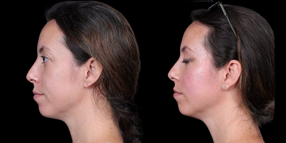 Laser Resurfacing Before & After Gallery - Patient 375310 - Image 4