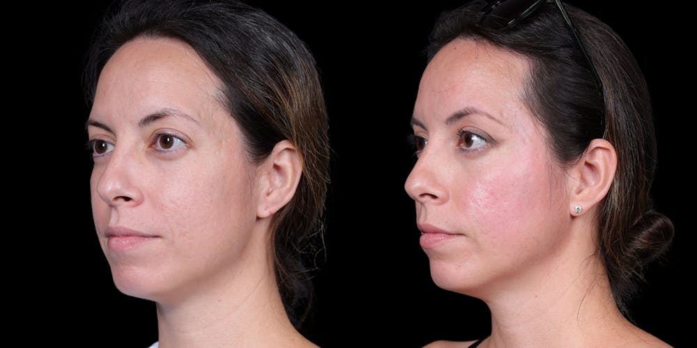 Laser Resurfacing Before & After Gallery - Patient 375310 - Image 5