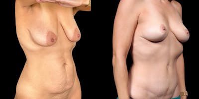Mommy Makeover Before & After Gallery - Patient 505043 - Image 2