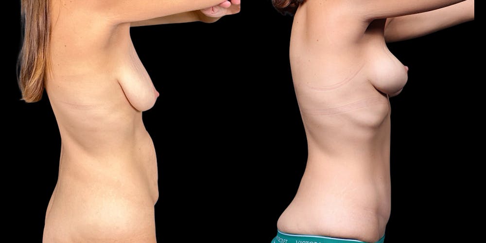 Mommy Makeover Before & After Gallery - Patient 505043 - Image 3