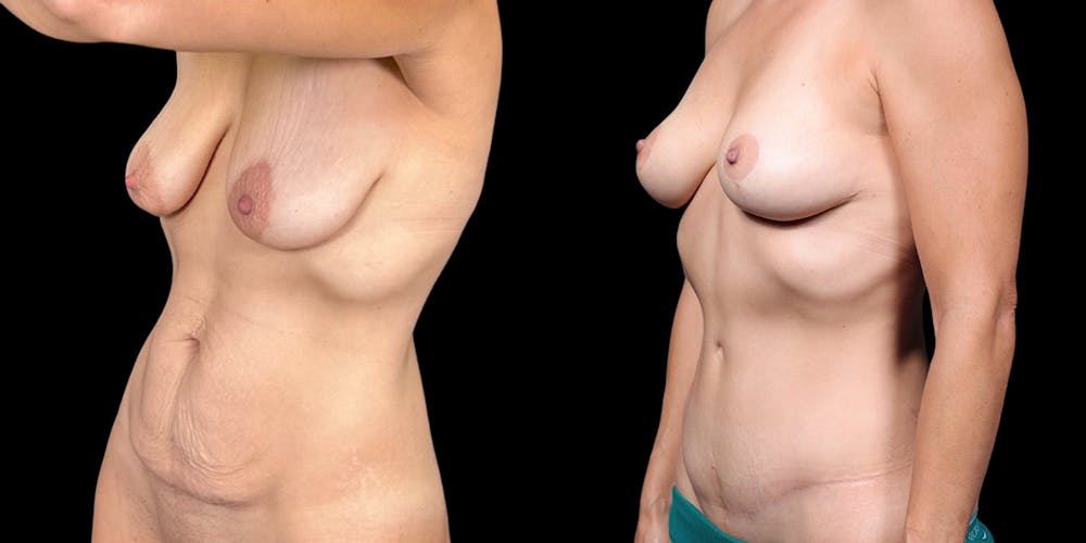 Mommy Makeover Before & After Gallery - Patient 505043 - Image 4