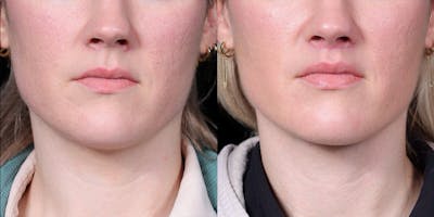 Lip Lift Before & After Gallery - Patient 293552 - Image 1