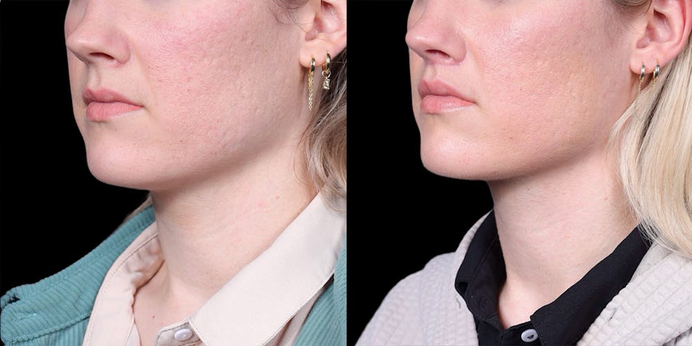 Lip Lift Before & After Gallery - Patient 293552 - Image 4