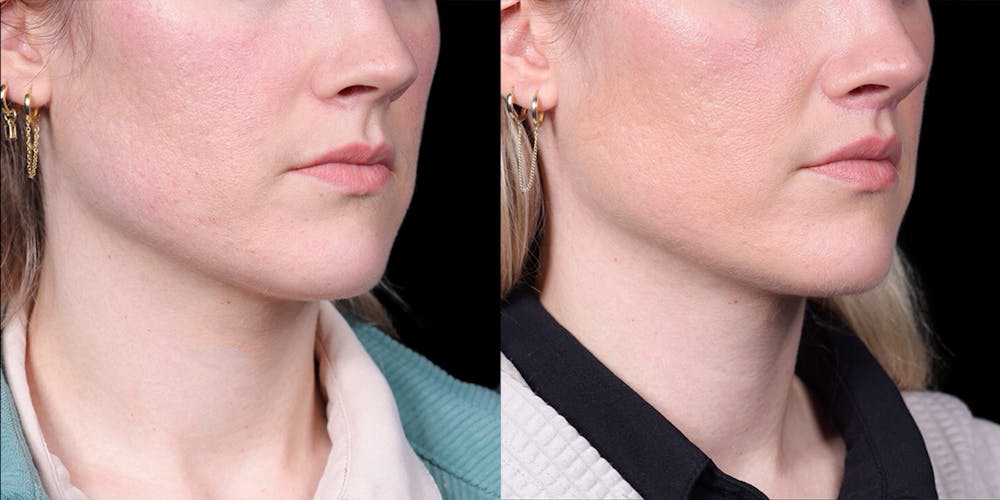 Lip Lift Before & After Gallery - Patient 293552 - Image 2