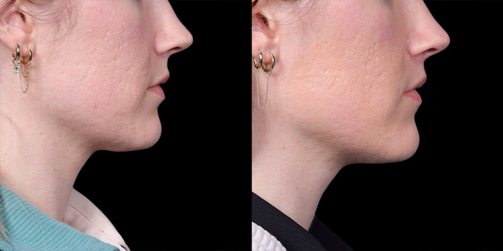 Lip Lift Before & After Gallery - Patient 293552 - Image 3