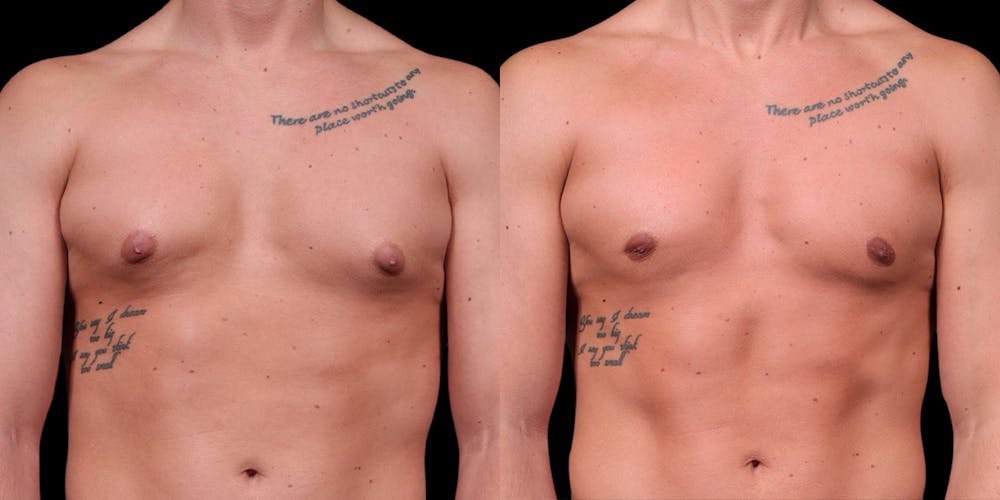 Gynecomastia Before & After Gallery - Patient 121439322 - Image 1