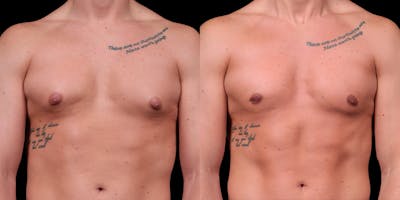 Gynecomastia Before & After Gallery - Patient 121439322 - Image 1