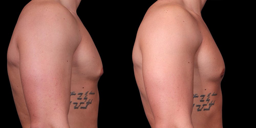 Gynecomastia Before & After Gallery - Patient 121439322 - Image 2