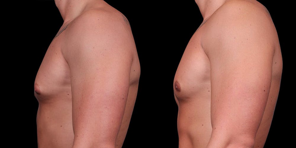 Gynecomastia Before & After Gallery - Patient 121439322 - Image 3