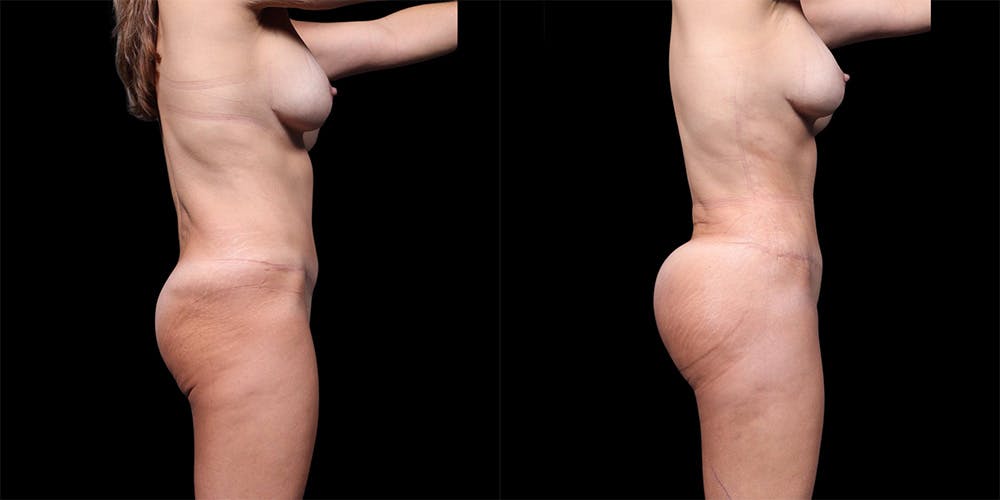 Buttock Implants Before & After Gallery - Patient 395439 - Image 4