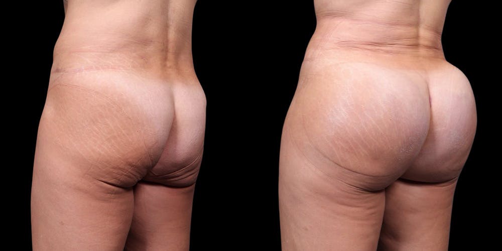 Buttock Implants Before & After Gallery - Patient 395439 - Image 2