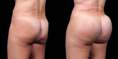 Buttock Implants Before & After Gallery - Patient 395439 - Image 2