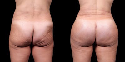 Brazilian Butt Lift Before & After Gallery - Patient 216271 - Image 1