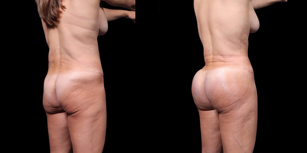 Buttock Implants Before & After Gallery - Patient 395439 - Image 3