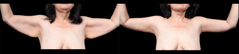 Arm Lift Before & After Gallery - Patient 130802 - Image 2