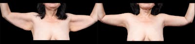 Arm Lift Before & After Gallery - Patient 130802 - Image 2
