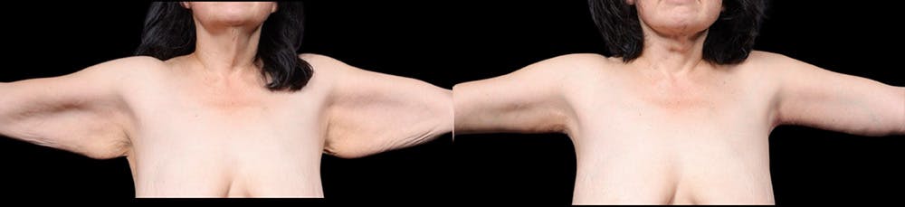 Arm Lift Before & After Gallery - Patient 130802 - Image 1