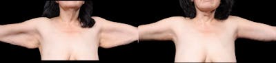 Arm Lift Before & After Gallery - Patient 130802 - Image 1