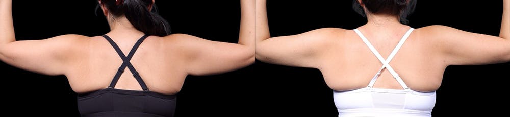 Arm Lift Before & After Gallery - Patient 187506 - Image 4