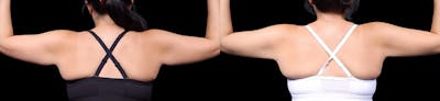 Arm Lift Before & After Gallery - Patient 187506 - Image 4