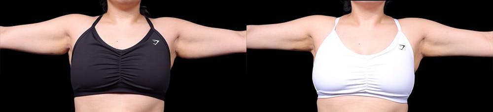 Arm Lift Before & After Gallery - Patient 187506 - Image 2