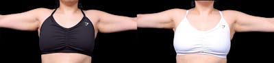 Arm Lift Before & After Gallery - Patient 187506 - Image 2