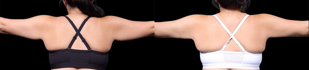 Arm Lift Before & After Gallery - Patient 187506 - Image 3