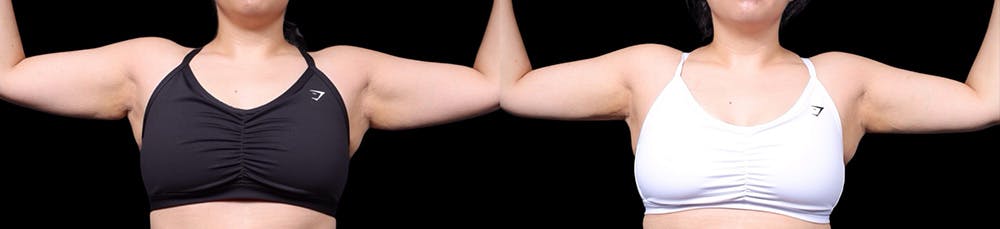 Arm Lift Before & After Gallery - Patient 187506 - Image 1