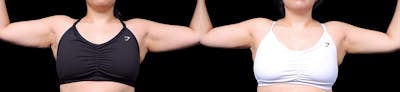 Arm Lift Before & After Gallery - Patient 187506 - Image 1