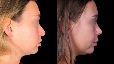 Rhinoplasty Before & After Gallery - Patient 333782 - Image 1