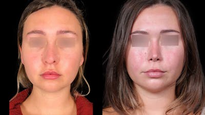 Rhinoplasty Before & After Gallery - Patient 333782 - Image 4