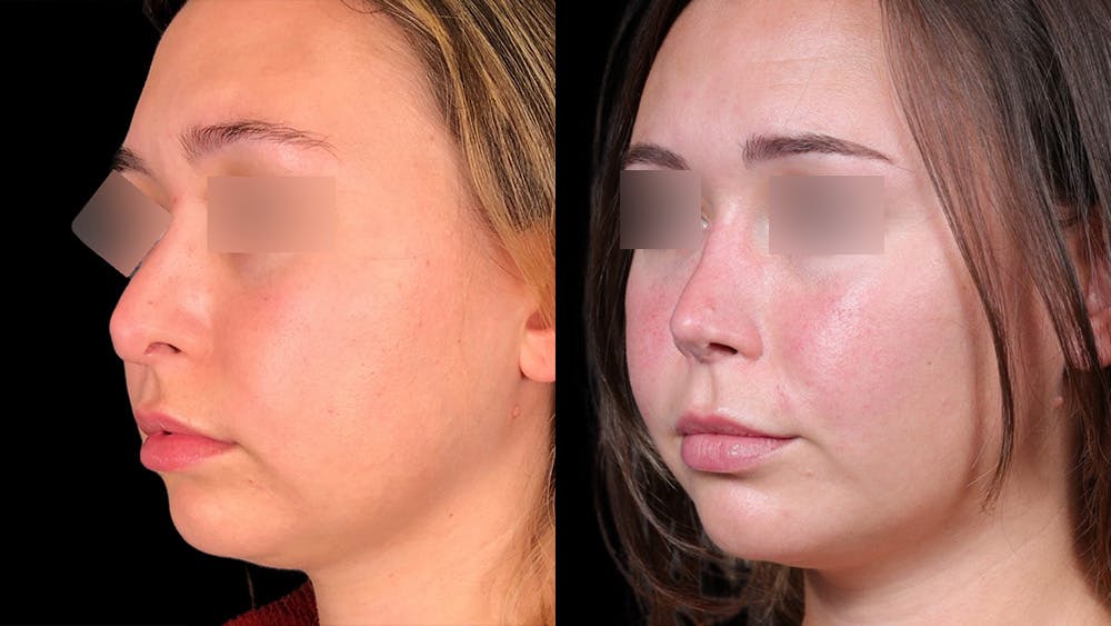 Rhinoplasty Before & After Gallery - Patient 333782 - Image 2