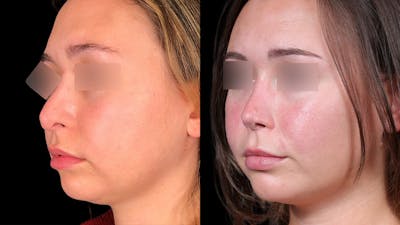 Rhinoplasty Before & After Gallery - Patient 333782 - Image 2