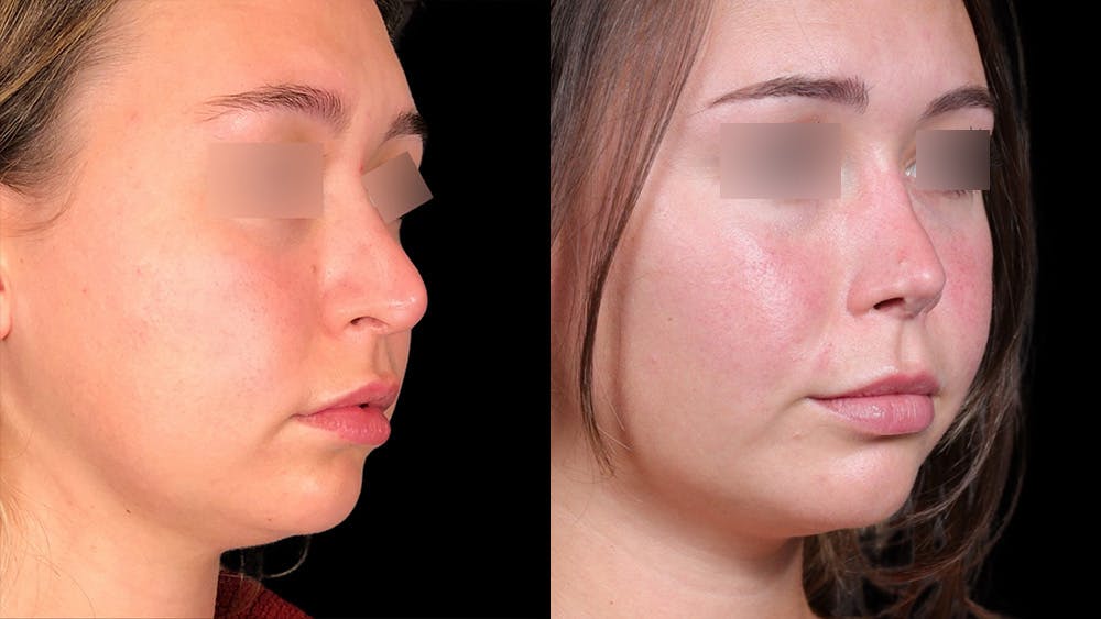 Rhinoplasty Before & After Gallery - Patient 333782 - Image 3