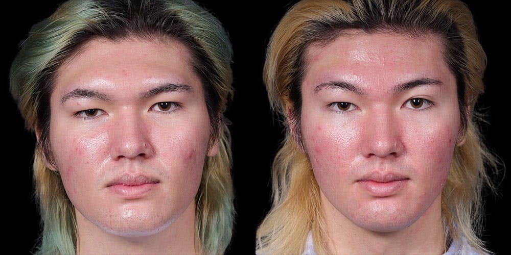Brow Contouring Before & After Gallery - Patient 415869 - Image 1