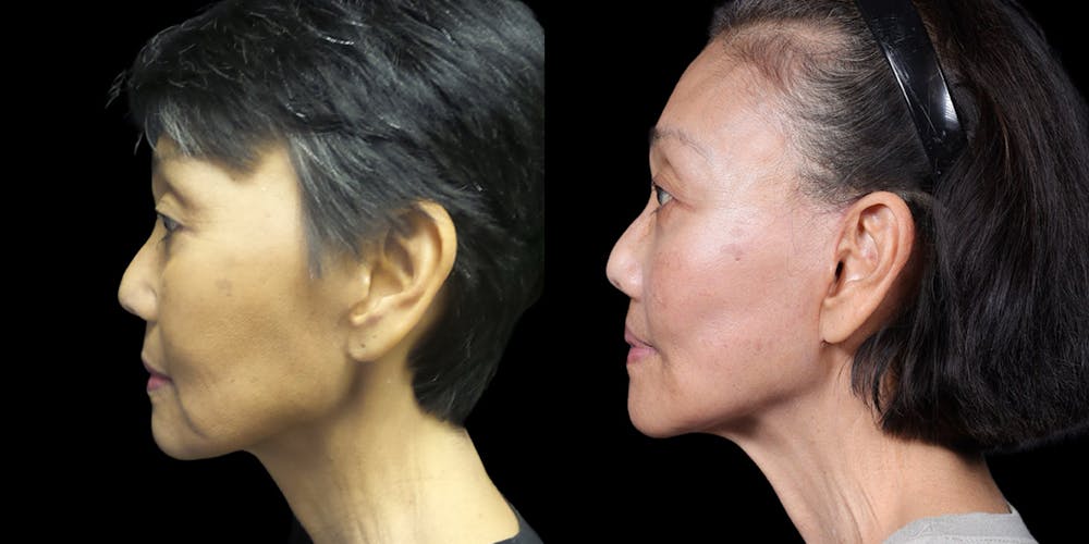 Facelift Before & After Gallery - Patient 130864 - Image 5