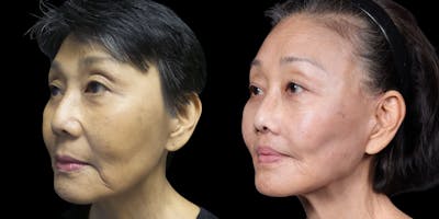 Facelift Before & After Gallery - Patient 130864 - Image 4