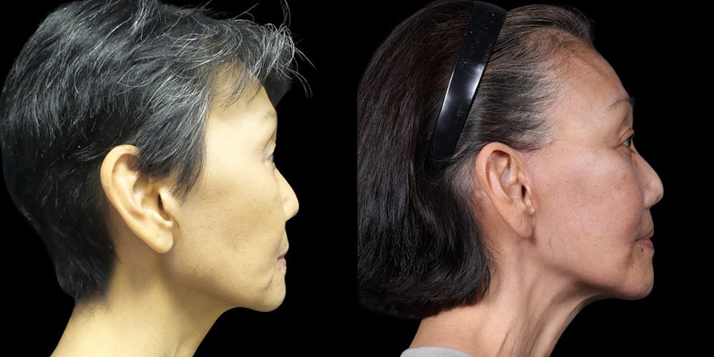 Facelift Before & After Gallery - Patient 130864 - Image 3