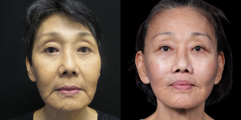 Facelift Before & After Gallery - Patient 130864 - Image 1