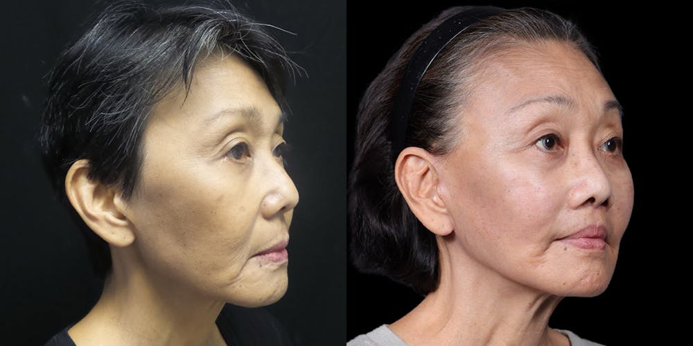 Facelift Before & After Gallery - Patient 130864 - Image 2
