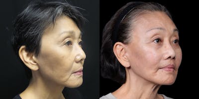 Facelift Before & After Gallery - Patient 130864 - Image 2