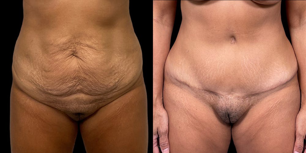Tummy Tuck Before & After Gallery - Patient 169712 - Image 1