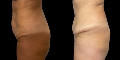 Tummy Tuck Before & After Gallery - Patient 169712 - Image 4