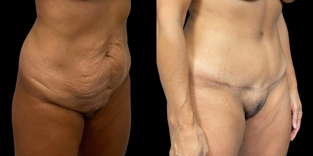Tummy Tuck Before & After Gallery - Patient 169712 - Image 2